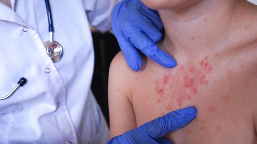 Minnesota's 80 measles cases this year are the most since 1990, health officials say — Plymouth Health news